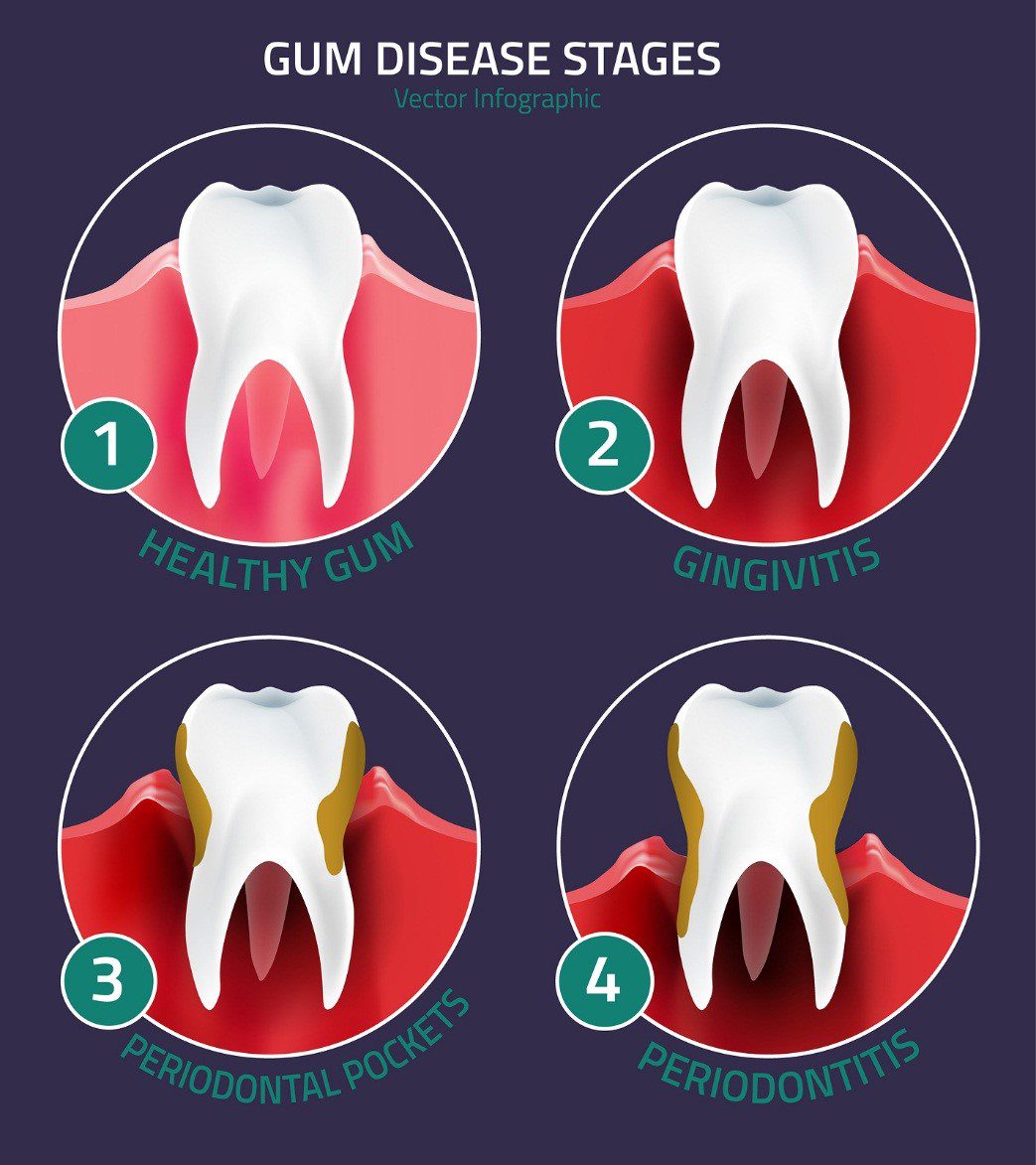Family Dentistry: Detecting the Early Warning Signs of Gum ...