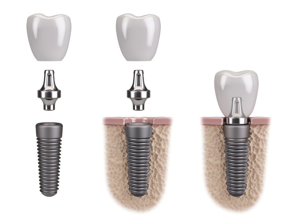 candidate for dental implants